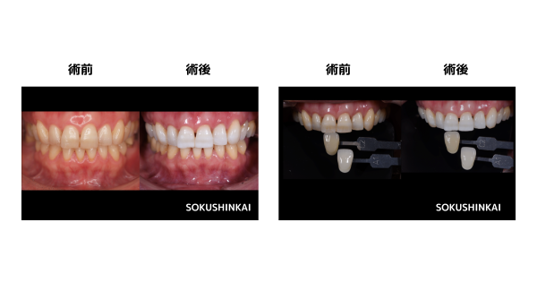 ホワイトニング　術前と術後の比較